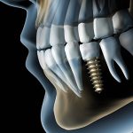 Что можно увидеть на 3д снимке зубов