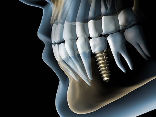 Что можно увидеть на 3д снимке зубов