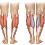 Можно ли исправить кривизну ног