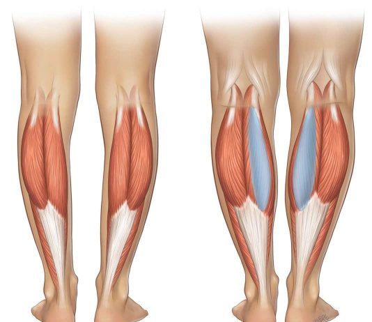 Можно ли исправить кривизну ног