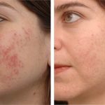 Какой эффект будет от мезотерапии лица