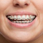 Как работают брекет-системы