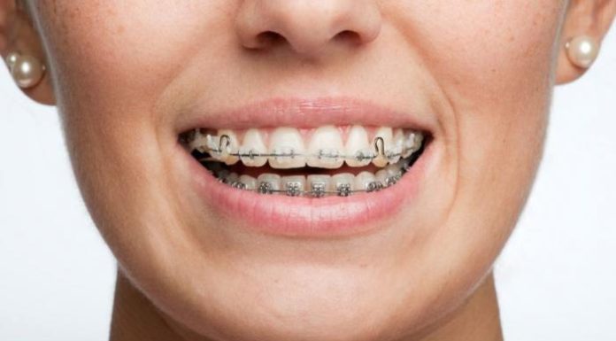 Как работают брекет-системы