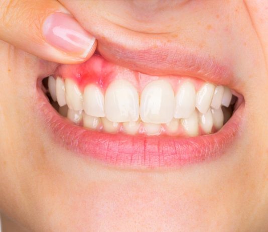 Как лечат воспаление десен в стоматологии