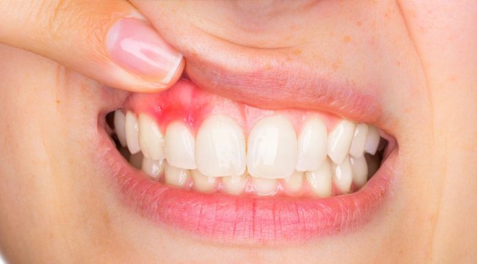 Как лечат воспаление десен в стоматологии