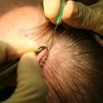 Как происходит процедура пересадки волос