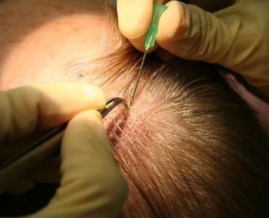 Как происходит процедура пересадки волос