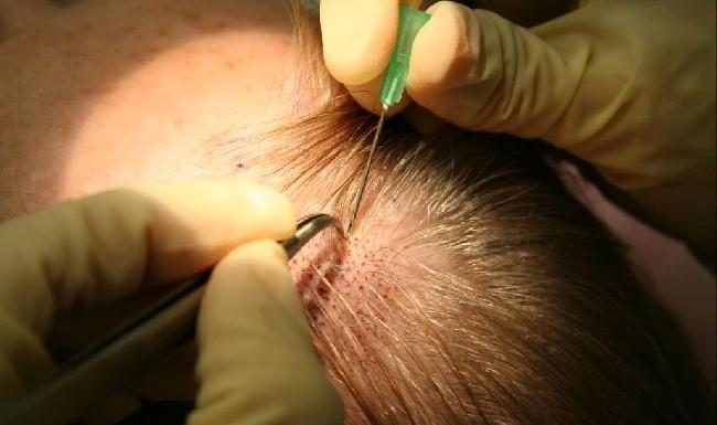 Как происходит процедура пересадки волос