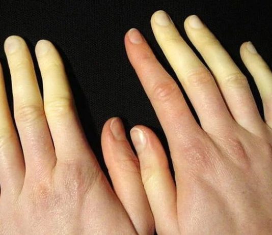 Почему возникает синдром Рейно