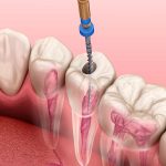 Что такое эндодонтическое лечение каналов