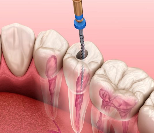 Что такое эндодонтическое лечение каналов