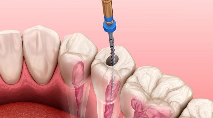 Что такое эндодонтическое лечение каналов