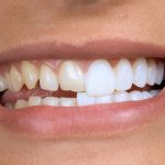 В каком случае нельзя ставить виниры на зубы