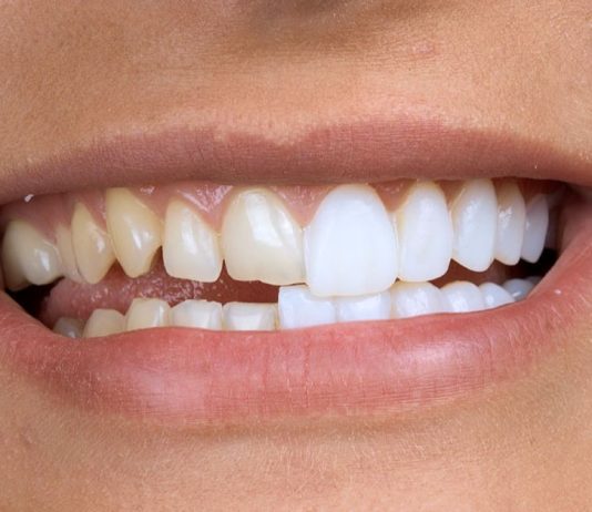 В каком случае нельзя ставить виниры на зубы
