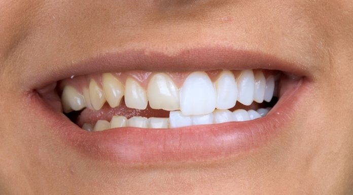 В каком случае нельзя ставить виниры на зубы