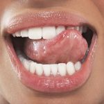 Что помогает быстро избавиться от стоматита