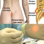 Операция по удалению кисты копчика