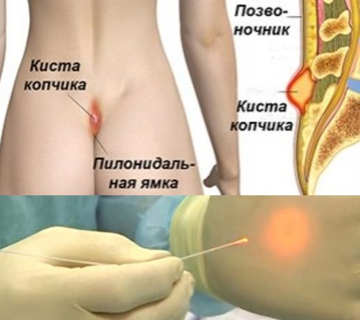 Операция по удалению кисты копчика