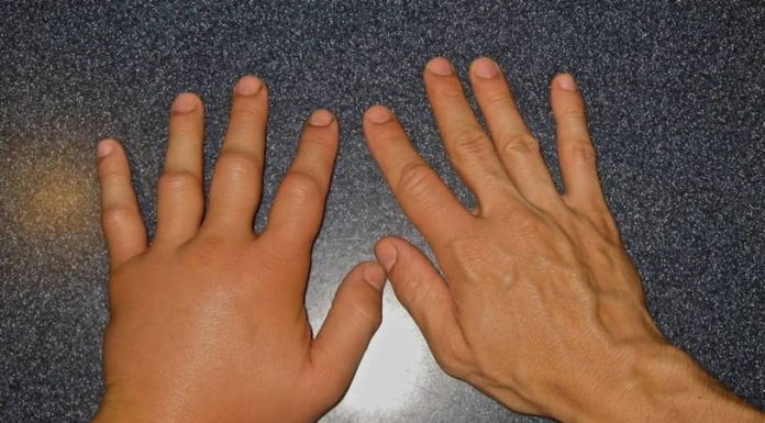 Почему может опухать рука