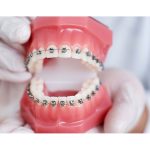 Как долго длится исправление прикуса брекетами?