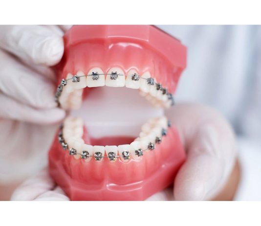 Как долго длится исправление прикуса брекетами?