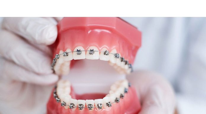 Как долго длится исправление прикуса брекетами?