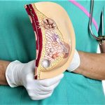 Рак молочной железы: симптомы, методы диагностики