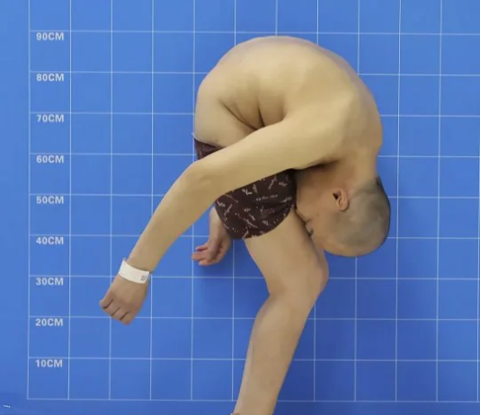 Болезнь Бехтерева: симптомы и лечение