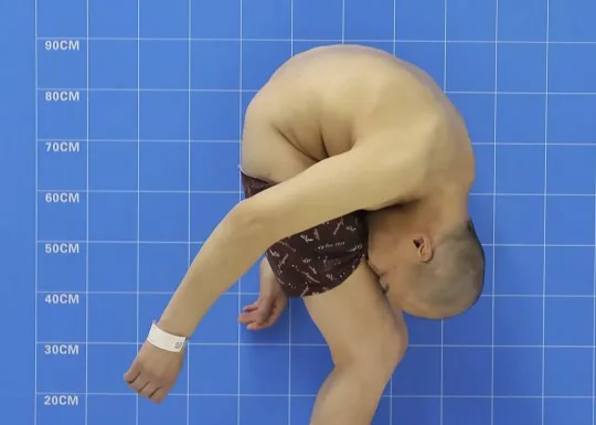 Болезнь Бехтерева: симптомы и лечение