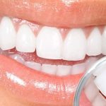 Современные методы отбеливания зубов