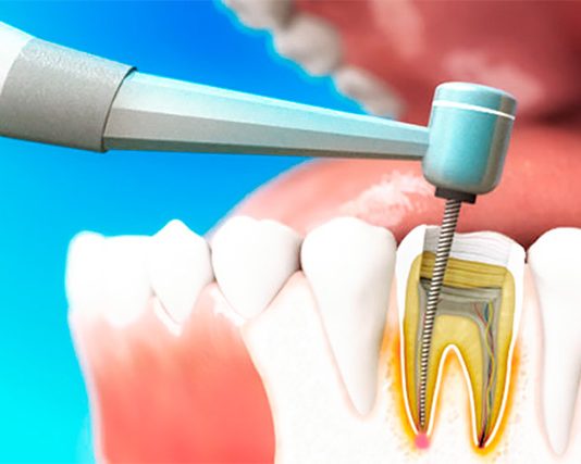 Как лечат пульпит