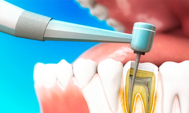 Как лечат пульпит