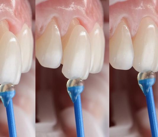 Преобразите свою улыбку с помощью установки виниров на зубы