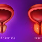Простатит: современные аспекты диагностики и лечения