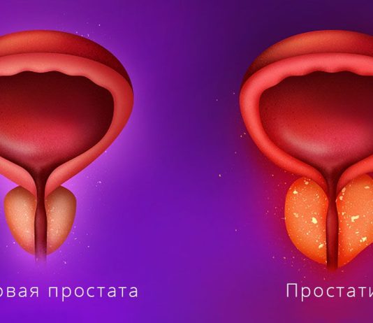 Простатит: современные аспекты диагностики и лечения