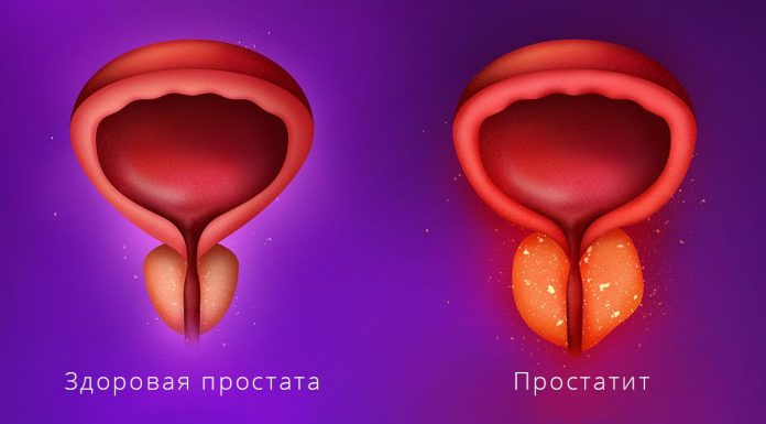 Простатит: современные аспекты диагностики и лечения