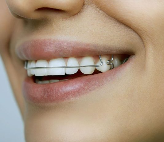 Пластины для зубов: Мгновенное преображение улыбки