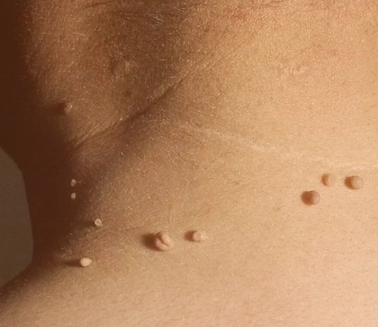 Эффективные методы борьбы с папилломами