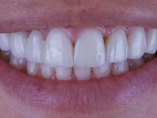 Кому можно а кому нельзя делать виниры