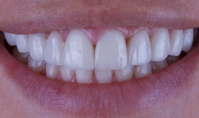 Кому можно а кому нельзя делать виниры