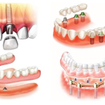 Протезирование зубов: особенности процедуры