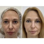 Блефаропластика: что за операция и кому она нужна