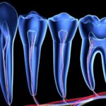 Что входит в эндодонтическое лечение