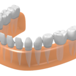 Можно ли сделать имплантацию зубов за один день