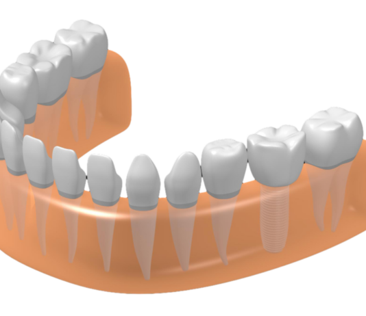 Можно ли сделать имплантацию зубов за один день