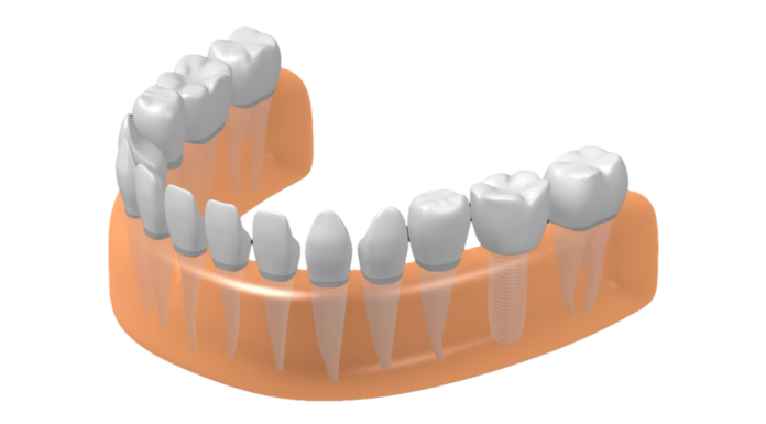 Можно ли сделать имплантацию зубов за один день