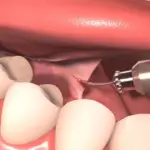 Подрезание уздечки языка: особенности процедуры для детей и взрослых