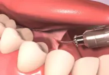 Подрезание уздечки языка: особенности процедуры для детей и взрослых