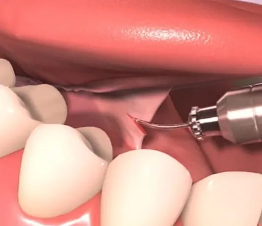 Подрезание уздечки языка: особенности процедуры для детей и взрослых