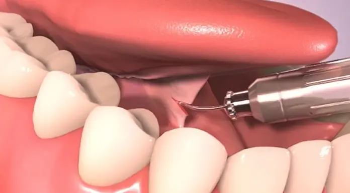 Подрезание уздечки языка: особенности процедуры для детей и взрослых